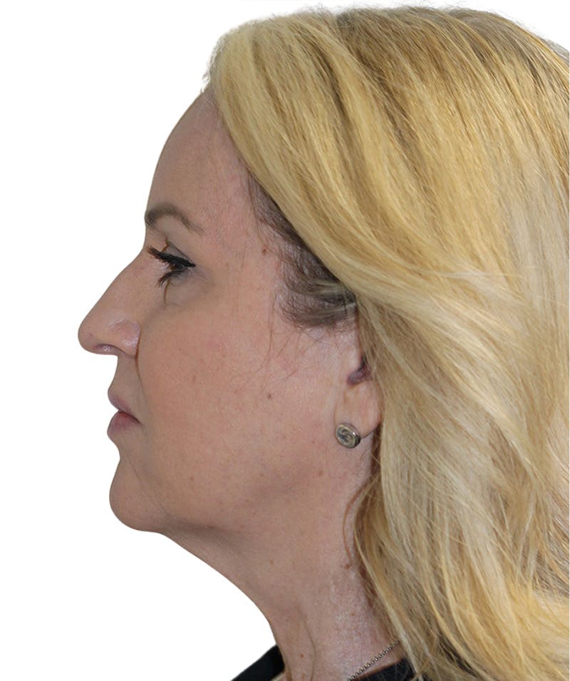 Facelift Before & After Gallery - Patient 418142 - Image 3