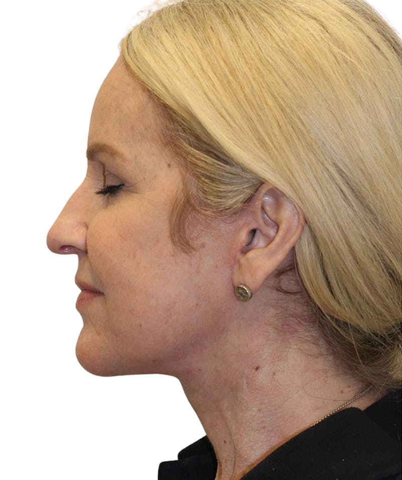 Facelift Before & After Gallery - Patient 418142 - Image 4