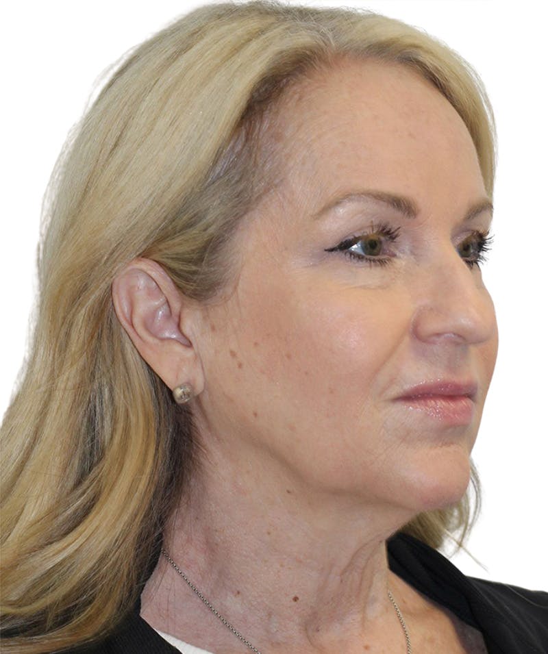 Facelift Before & After Gallery - Patient 418142 - Image 5