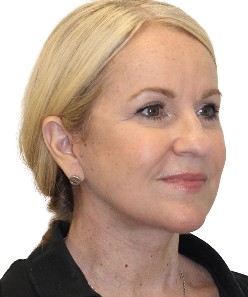 Facelift Before & After Gallery - Patient 418142 - Image 6