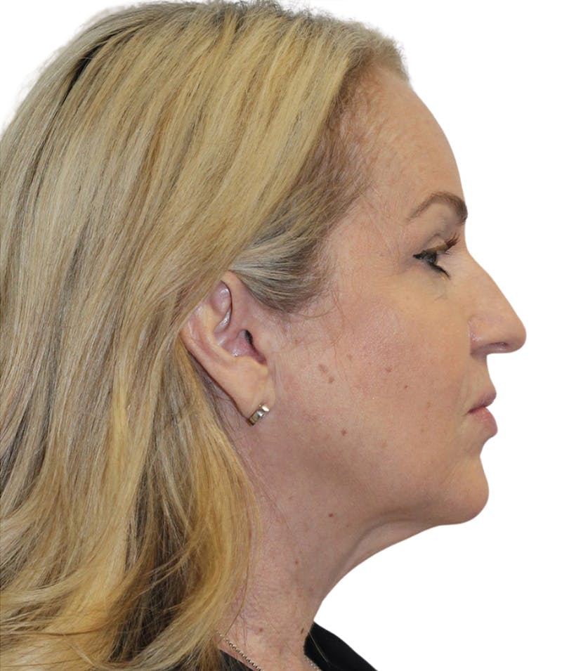 Facelift Before & After Gallery - Patient 418142 - Image 7