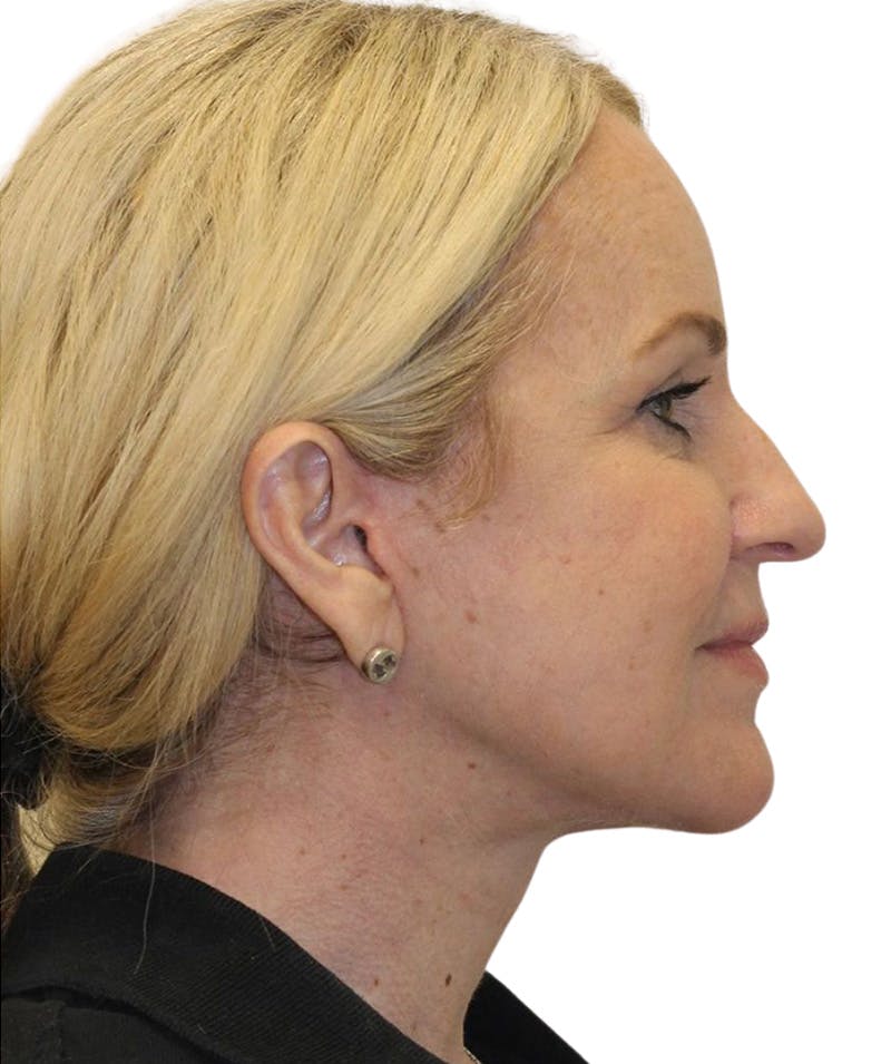 Facelift Before & After Gallery - Patient 418142 - Image 8