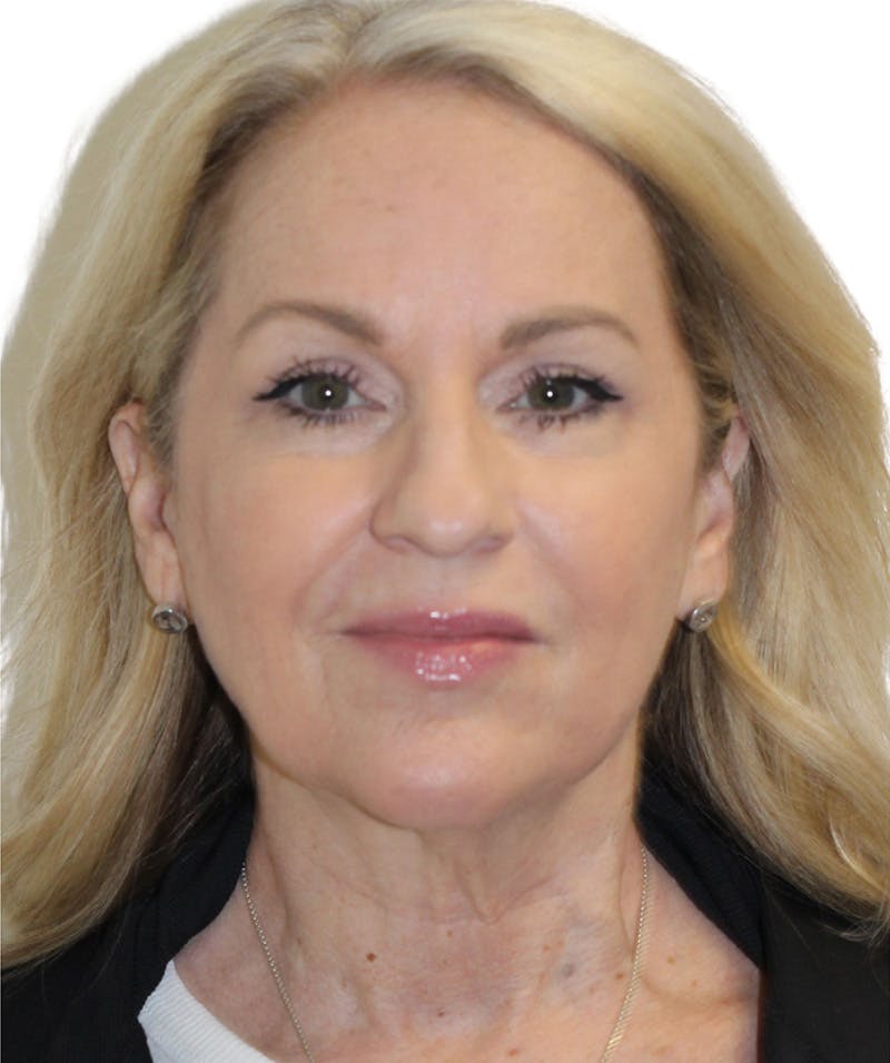 Facelift Before & After Gallery - Patient 418142 - Image 9
