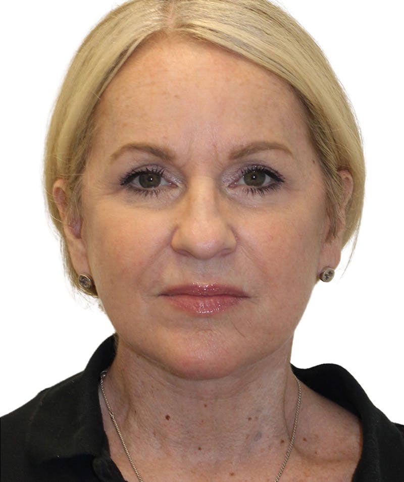 Facelift Before & After Gallery - Patient 418142 - Image 10