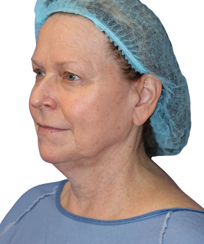 Facelift Before & After Gallery - Patient 213386 - Image 1