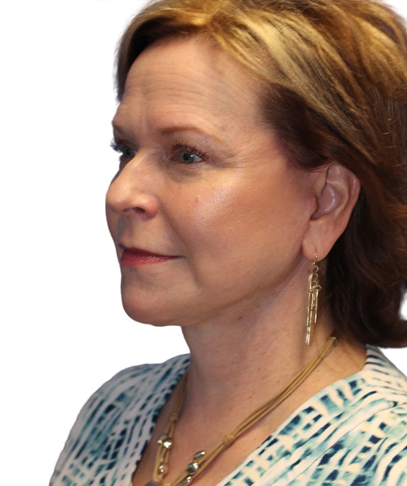 Facelift Before & After Gallery - Patient 213386 - Image 2