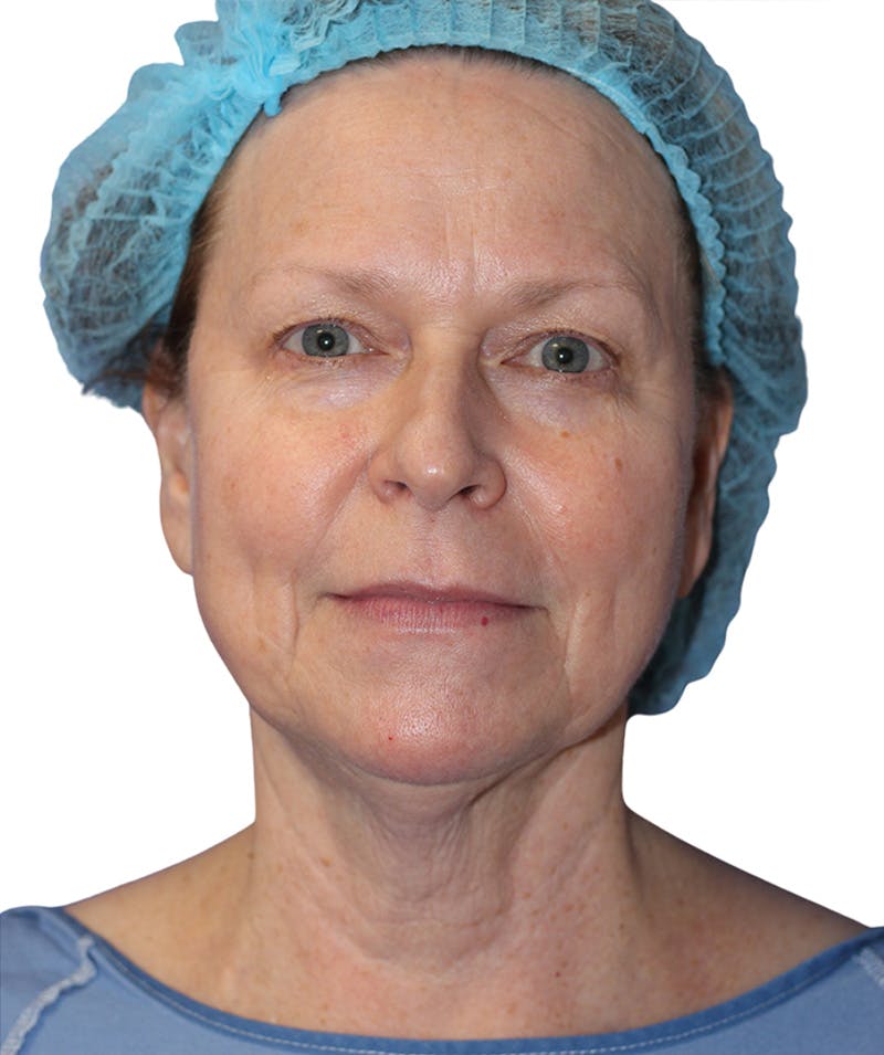 Facelift Before & After Gallery - Patient 213386 - Image 3