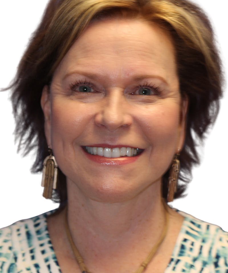 Facelift Before & After Gallery - Patient 213386 - Image 4