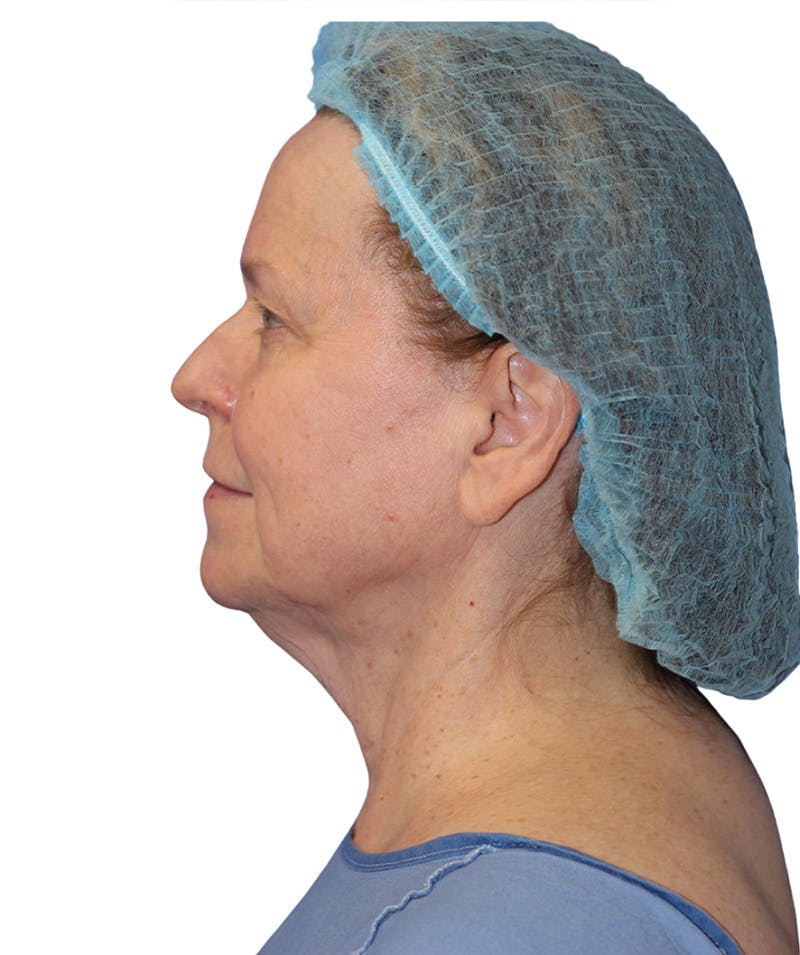 Facelift Before & After Gallery - Patient 213386 - Image 5
