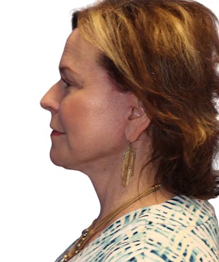 Facelift Before & After Gallery - Patient 213386 - Image 6