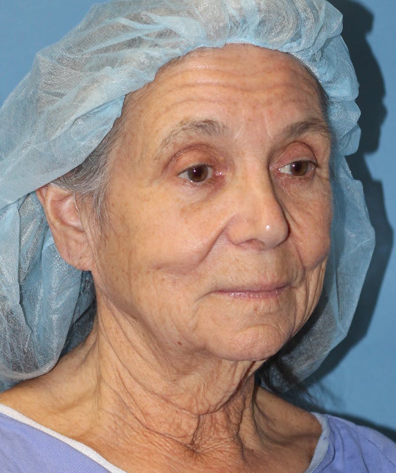 Facelift Before & After Gallery - Patient 189603 - Image 1