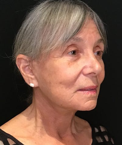 Facelift Before & After Gallery - Patient 189603 - Image 2