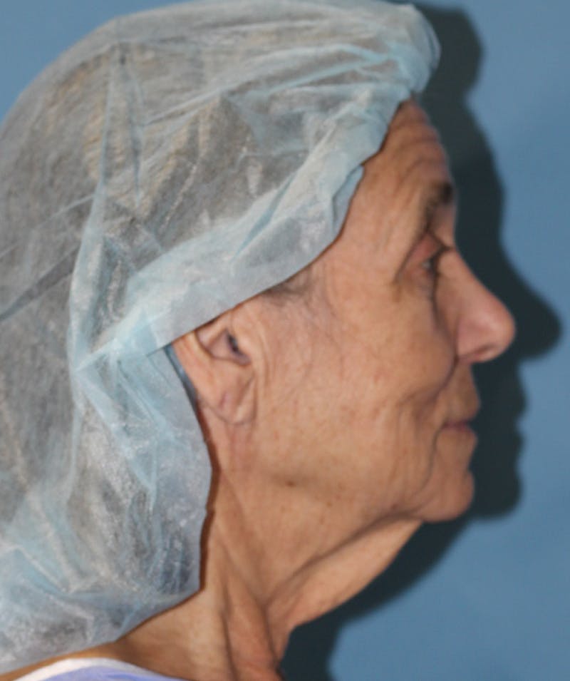 Facelift Before & After Gallery - Patient 189603 - Image 3