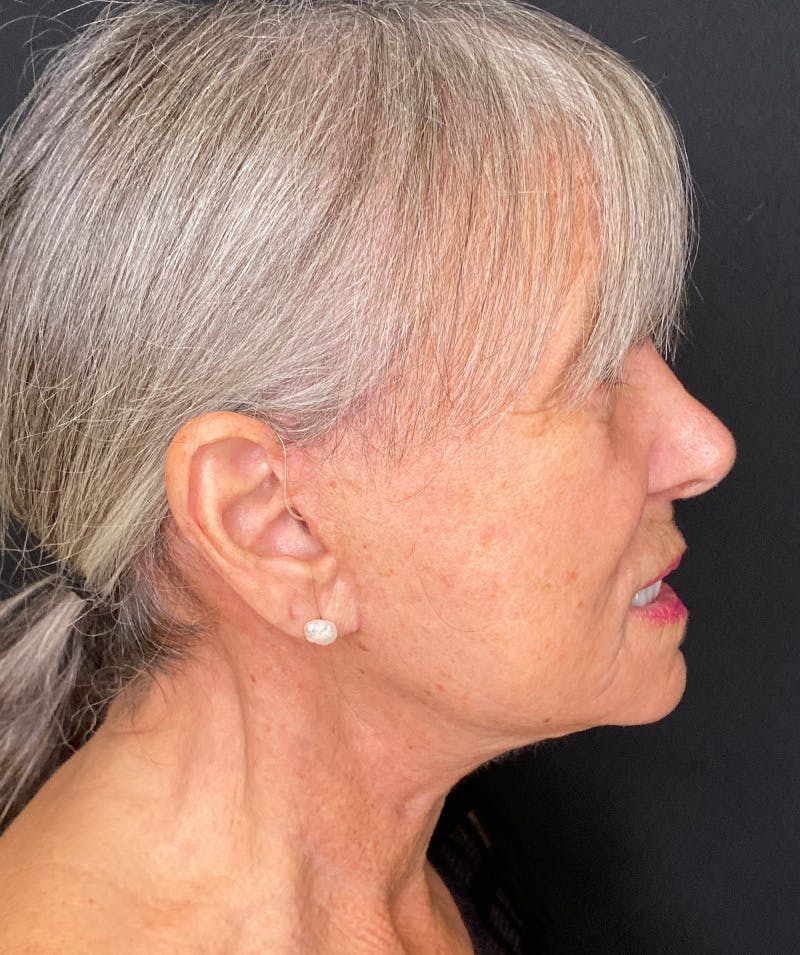 Facelift Before & After Gallery - Patient 189603 - Image 4