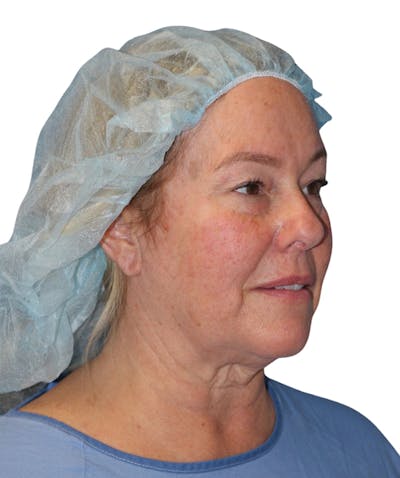 Facelift Before & After Gallery - Patient 307754 - Image 1