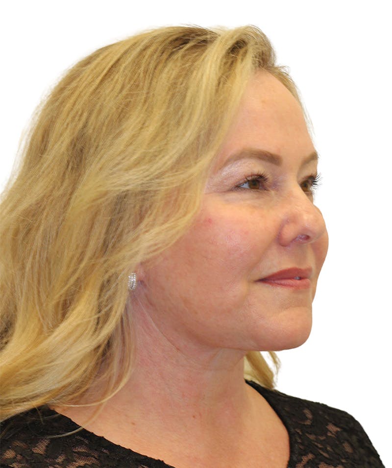 Facelift Before & After Gallery - Patient 307754 - Image 2