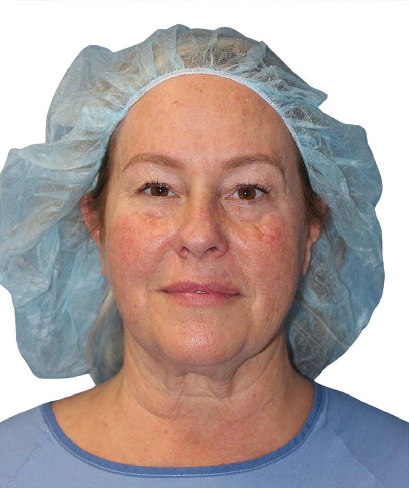 Facelift Before & After Gallery - Patient 307754 - Image 3