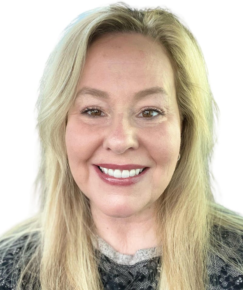 Facelift Before & After Gallery - Patient 307754 - Image 4