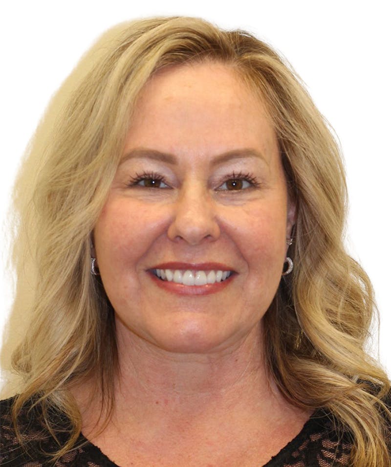 Facelift Before & After Gallery - Patient 307754 - Image 6