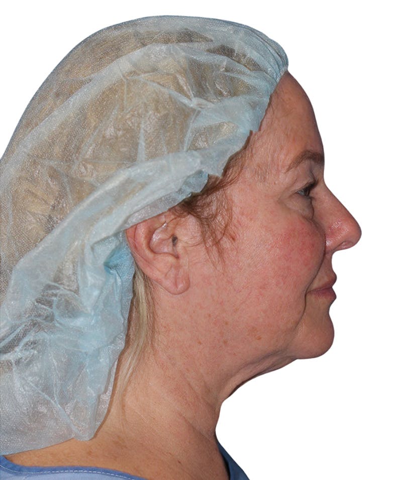Facelift Before & After Gallery - Patient 307754 - Image 7