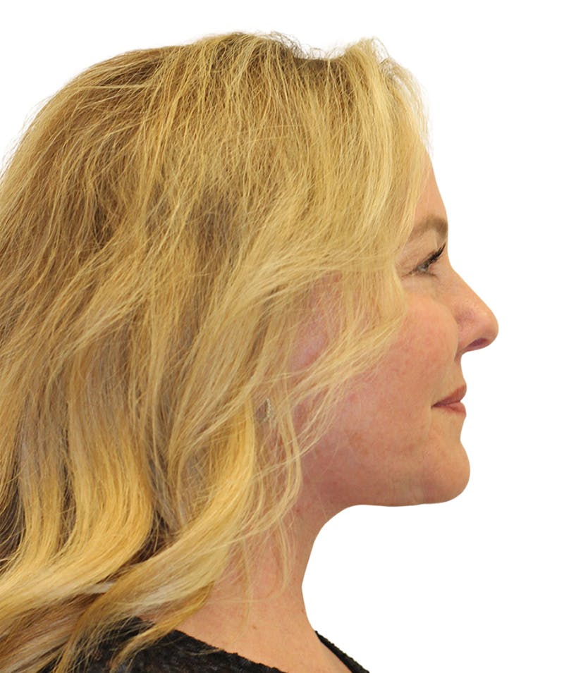 Facelift Before & After Gallery - Patient 307754 - Image 8