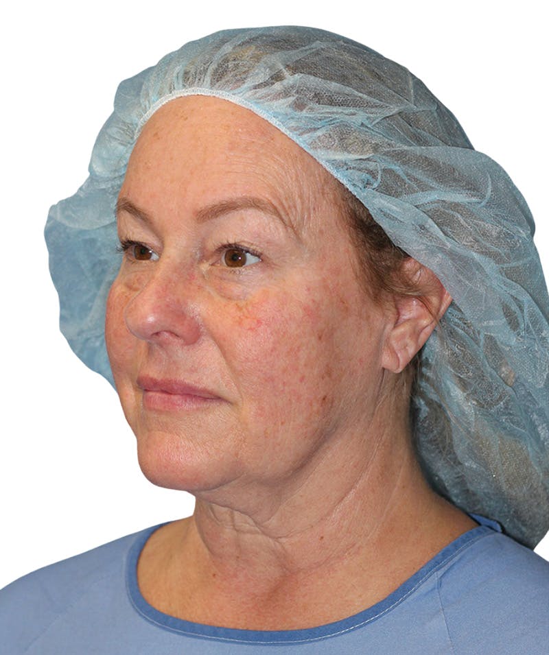Facelift Before & After Gallery - Patient 307754 - Image 9