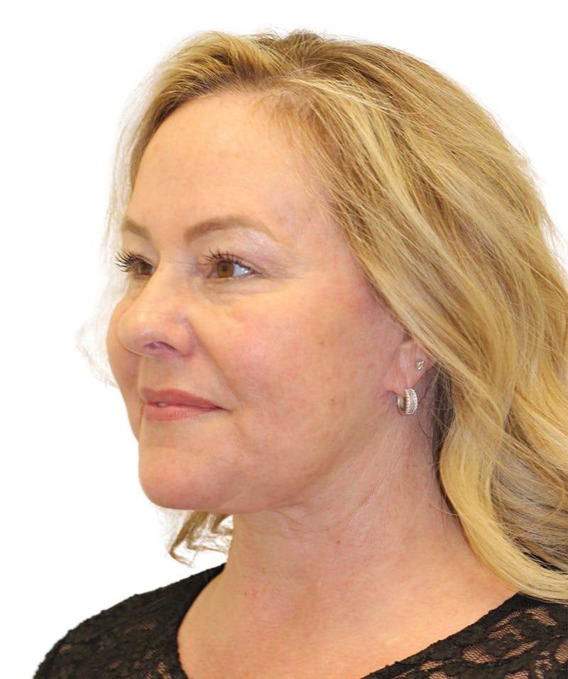 Facelift Before & After Gallery - Patient 307754 - Image 10