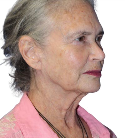 Facelift Before & After Gallery - Patient 395464 - Image 1