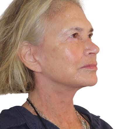 Facelift Before & After Gallery - Patient 395464 - Image 2