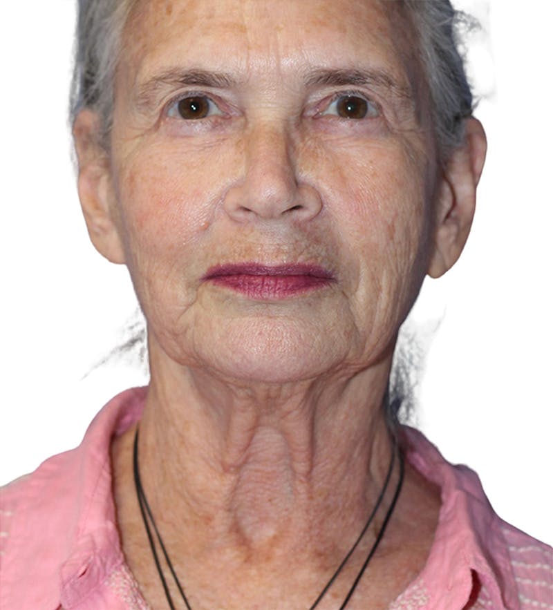 Facelift Before & After Gallery - Patient 395464 - Image 3