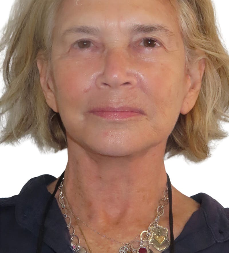 Facelift Before & After Gallery - Patient 395464 - Image 4
