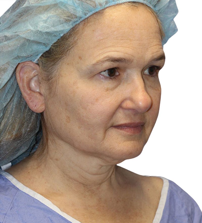 Facelift Before & After Gallery - Patient 390065 - Image 1