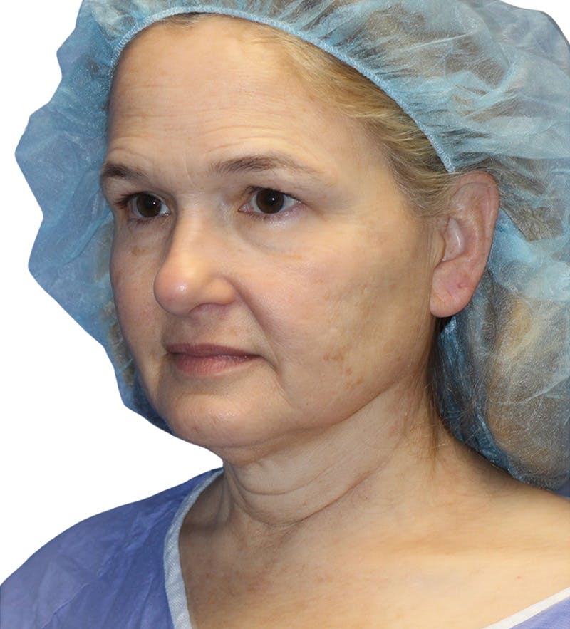 Facelift Before & After Gallery - Patient 390065 - Image 3