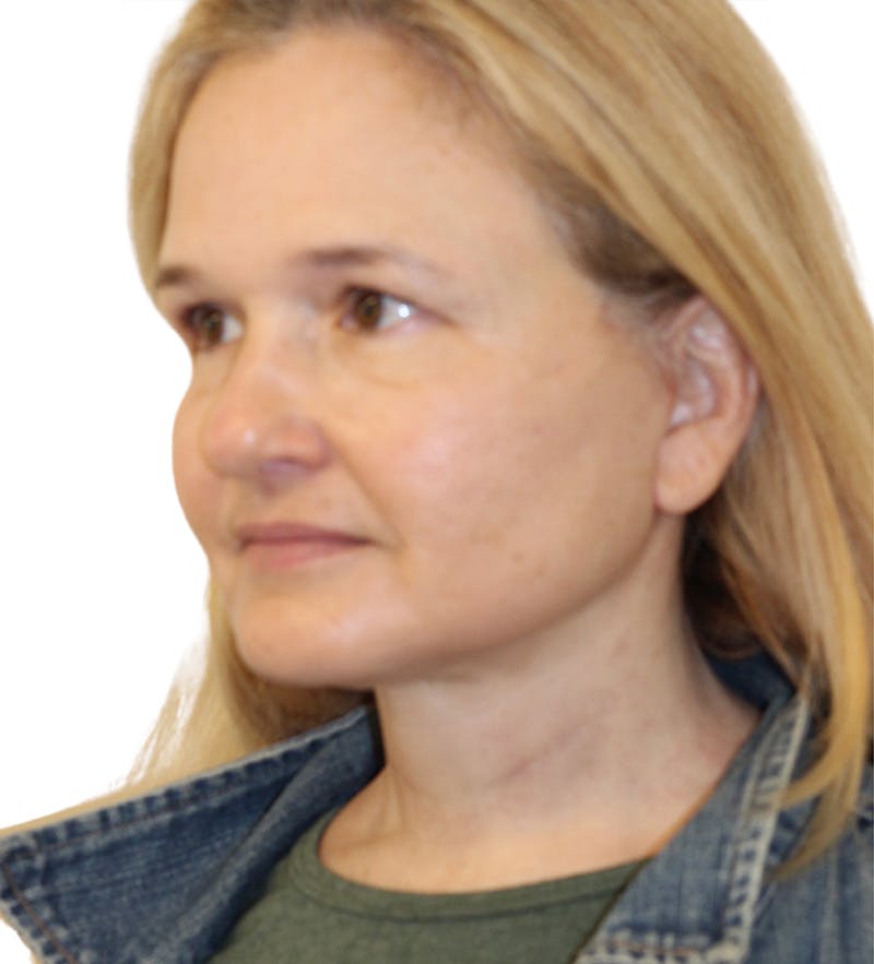 Facelift Before & After Gallery - Patient 390065 - Image 4