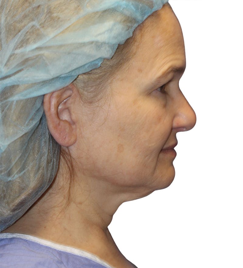 Facelift Before & After Gallery - Patient 390065 - Image 5