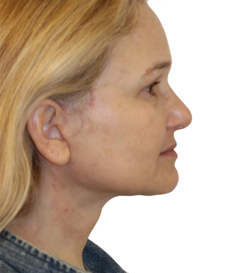 Facelift Before & After Gallery - Patient 390065 - Image 6