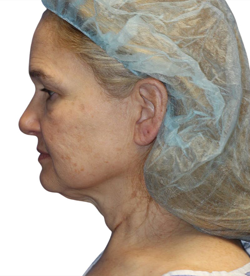 Facelift Before & After Gallery - Patient 390065 - Image 7