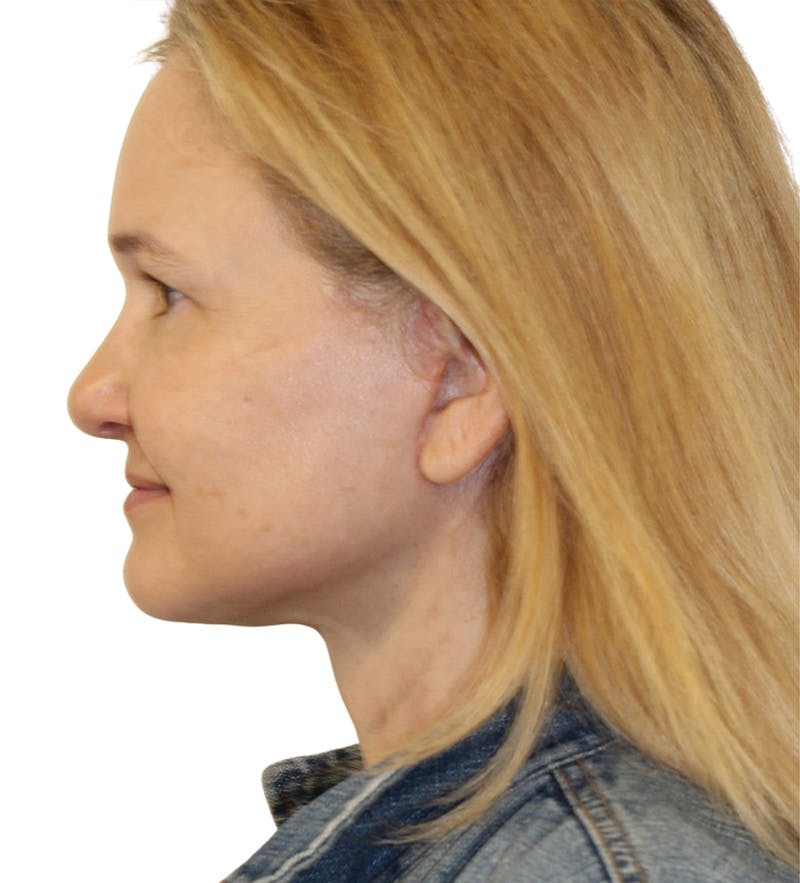 Facelift Before & After Gallery - Patient 390065 - Image 8