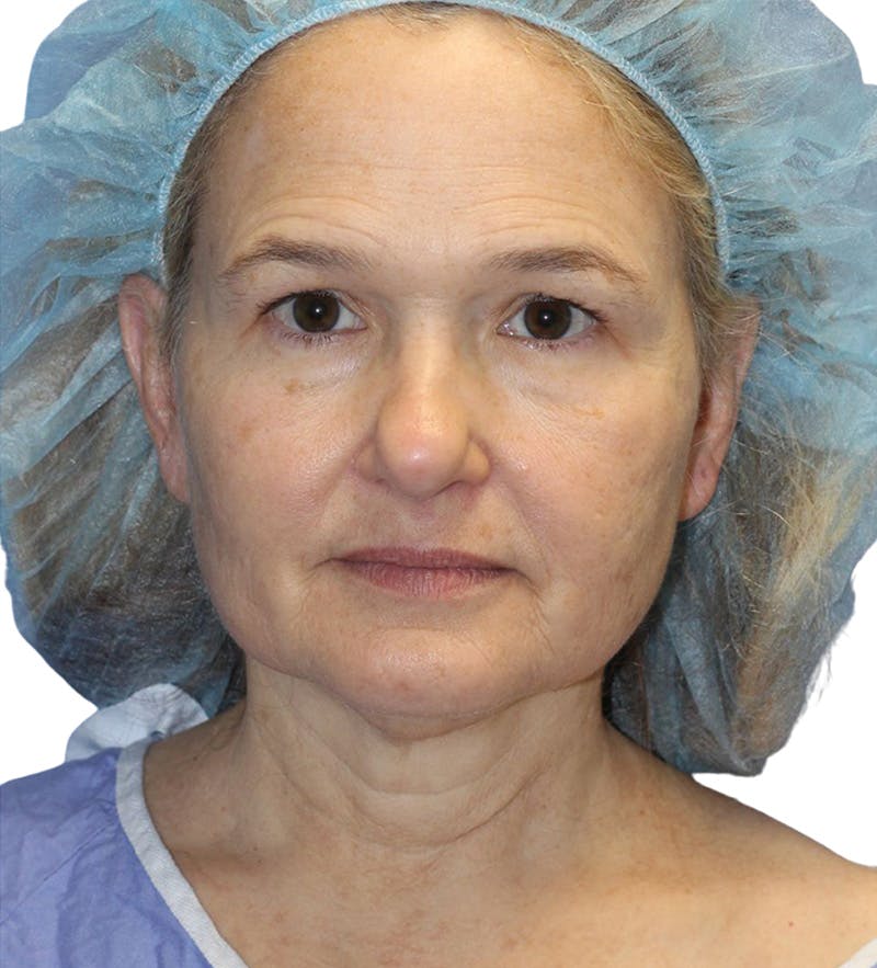 Facelift Before & After Gallery - Patient 390065 - Image 9
