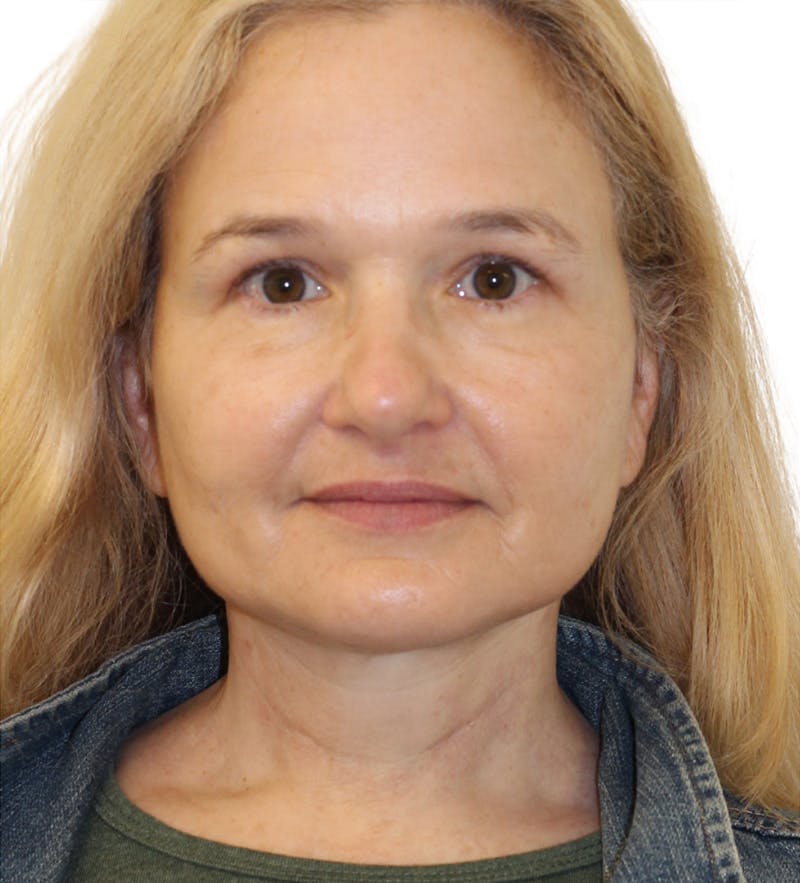 Facelift Before & After Gallery - Patient 390065 - Image 10