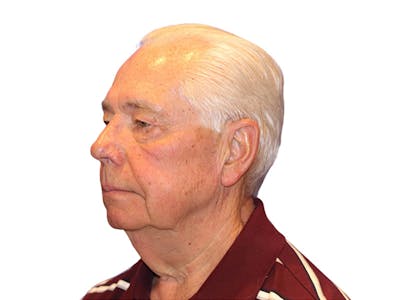 Facelift Before & After Gallery - Patient 767599 - Image 1