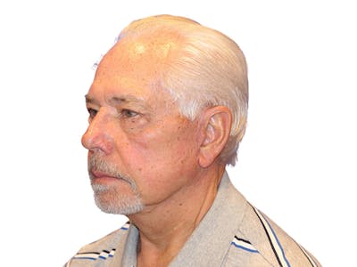 Facelift Before & After Gallery - Patient 767599 - Image 2