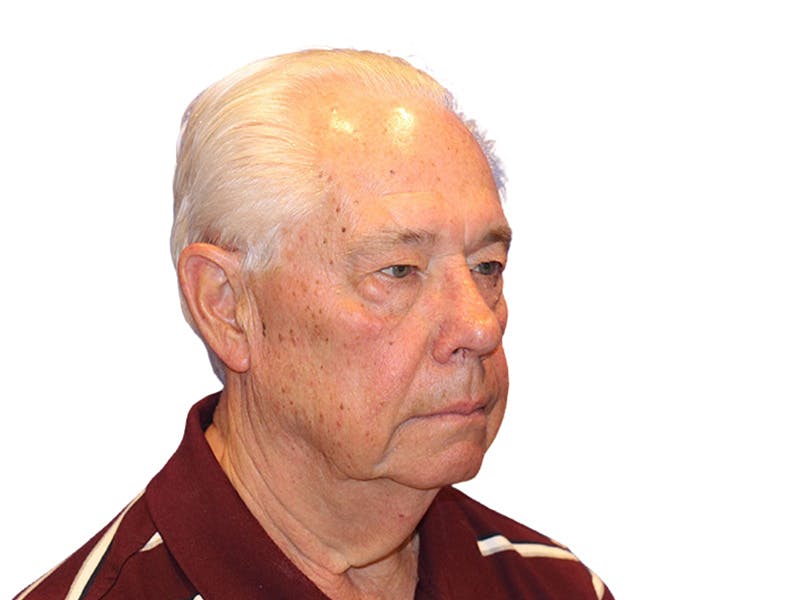 Facelift Before & After Gallery - Patient 767599 - Image 3