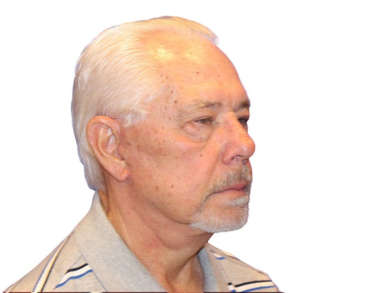 Facelift Before & After Gallery - Patient 767599 - Image 4