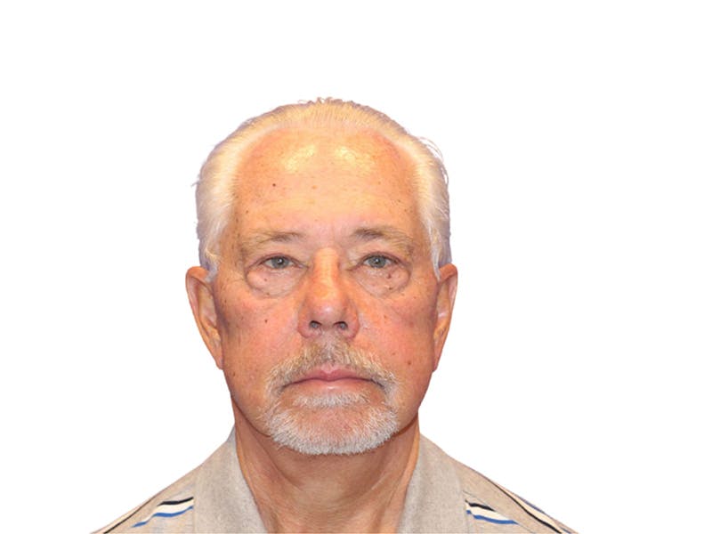 Facelift Before & After Gallery - Patient 767599 - Image 6