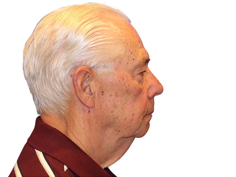 Facelift Before & After Gallery - Patient 767599 - Image 7