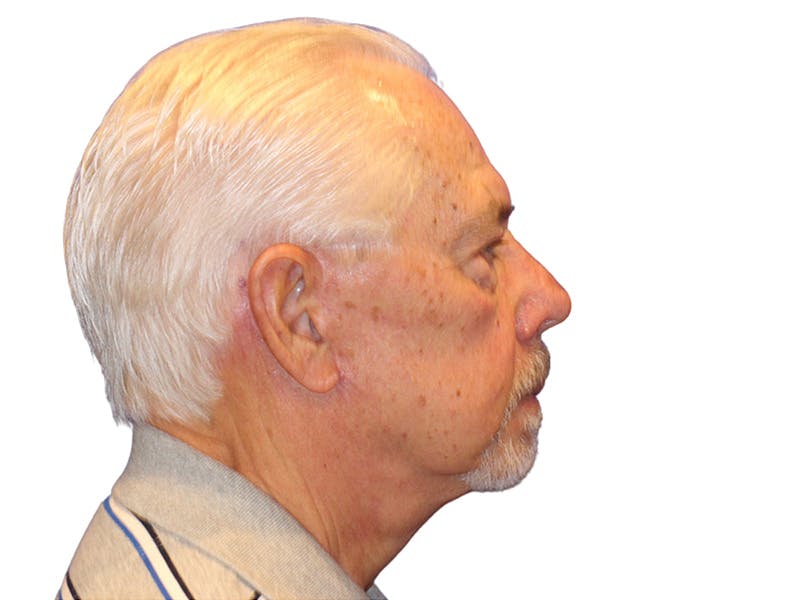 Facelift Before & After Gallery - Patient 767599 - Image 8