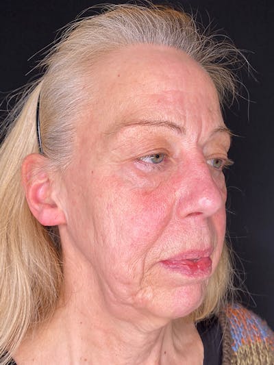 Facelift Before & After Gallery - Patient 143359 - Image 1