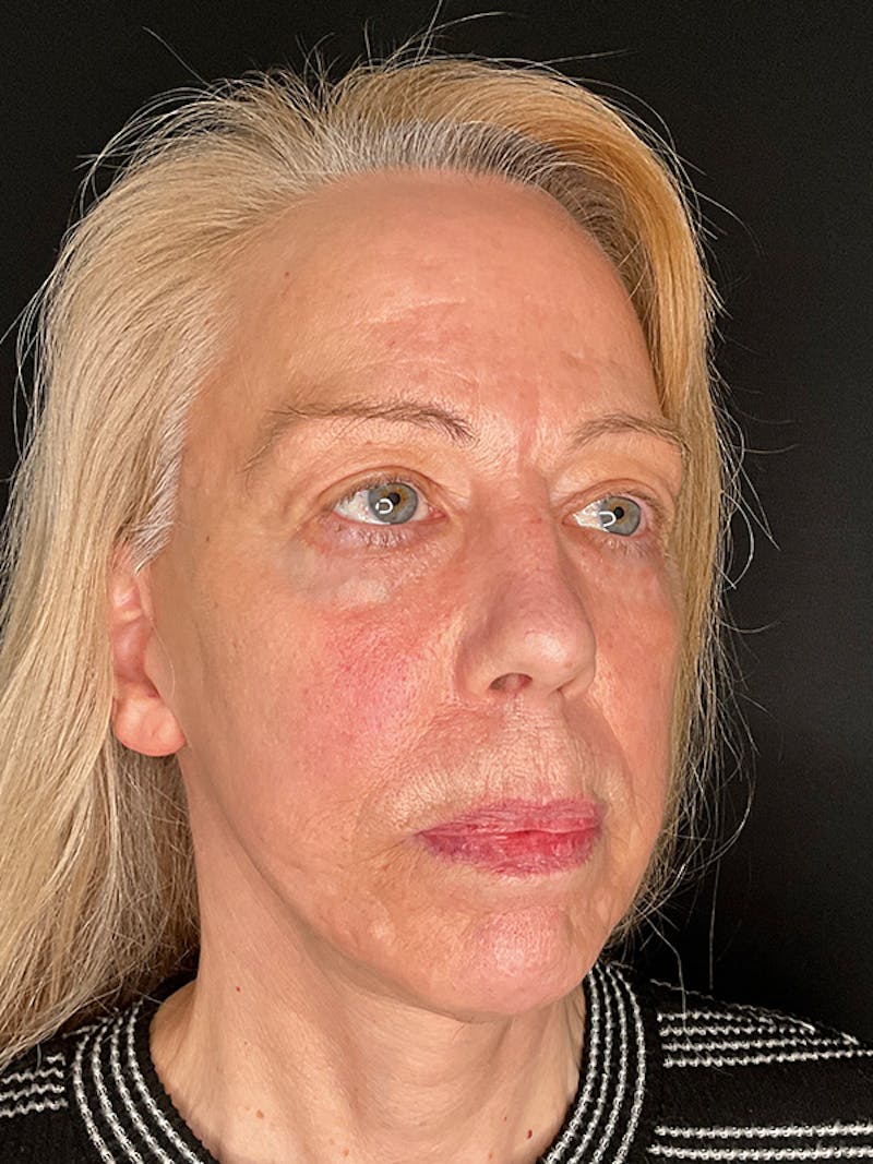 Facelift Before & After Gallery - Patient 143359 - Image 2