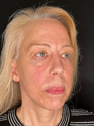 Facelift Before & After Gallery - Patient 143359 - Image 2